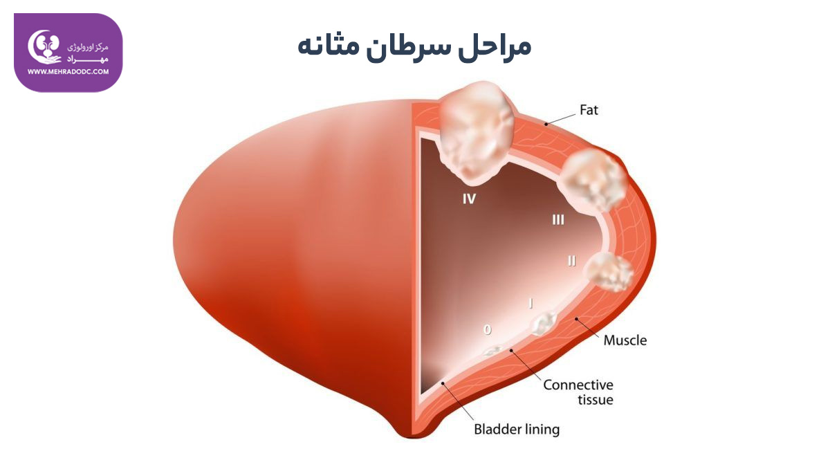 سرطان مثانه و درد مثانه | دکتر مهری مهراد اورولوژیست
