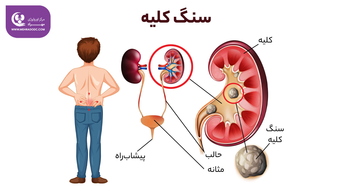 سنگ کلیه چیست | دکتر مهری مهراد / اورولوژیست