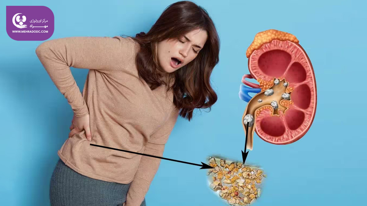 علائم کریستال‌های کلسیم اگزالات | مرکز اورولوژی مهراد