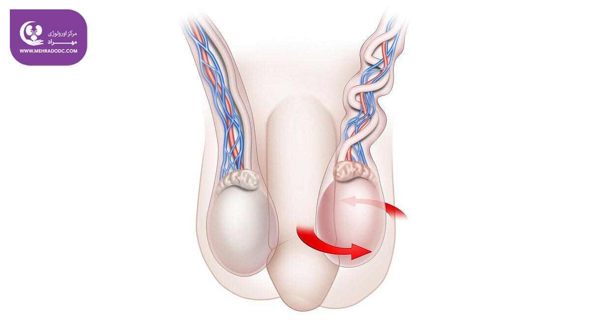پیچ خوردگی بیضه | دکتر مهری مهراد، اورولوژیست