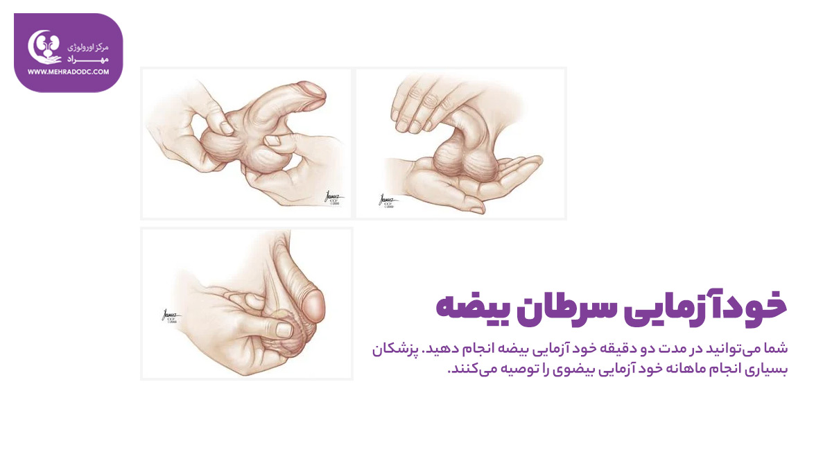 خودآزمایی سرطان بیضه | دکتر مهری مهراد، اورولوژیست