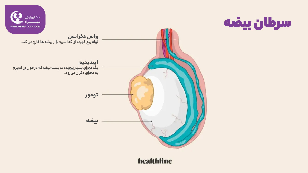 سرطان بیضه | دکتر مهری مهراد، متخصص اورولوژی در تهران