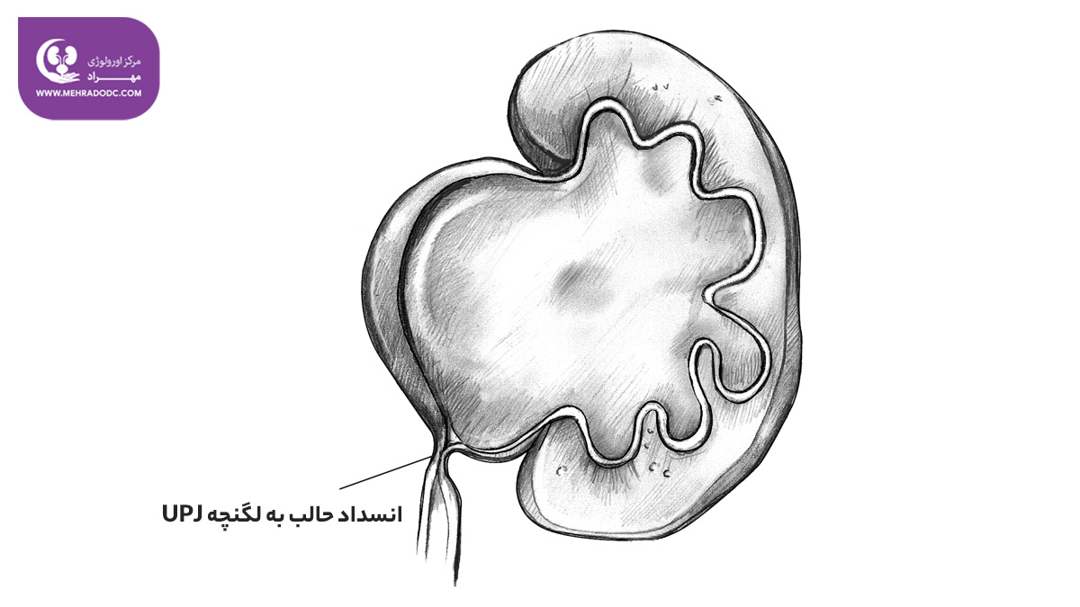 درمان انسداد حالب به لگنچه UPJ | دکتر مهری مهراد - متخصص اورولوژی