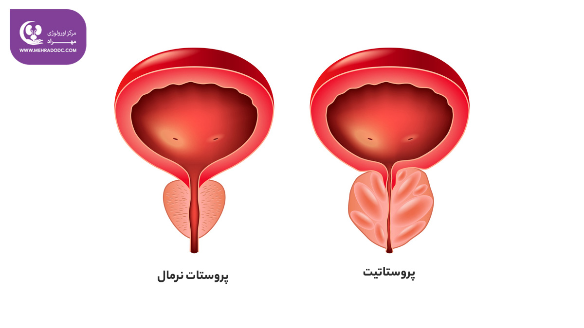 پروستاتیت | دکتر مهری مهراد، متخصص اورولوژی در تهران