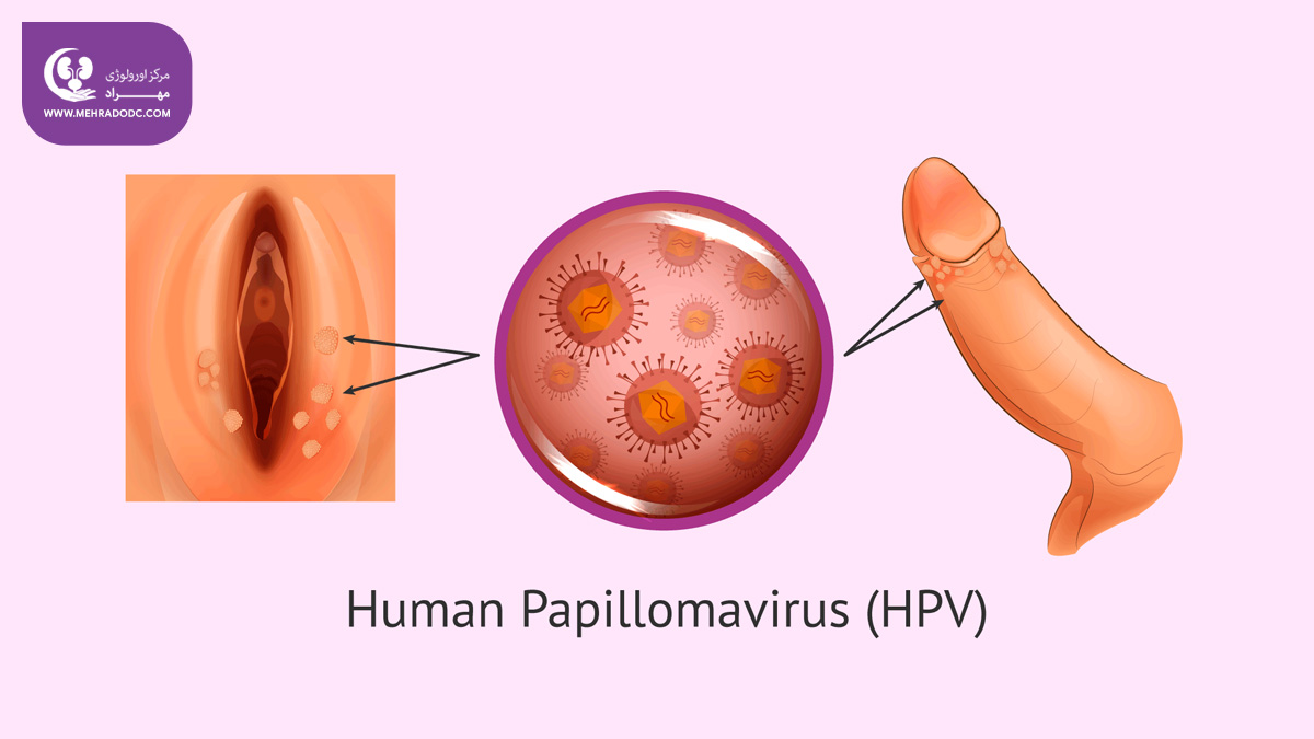 عفونت HPV یا پاپیلومای انسانی