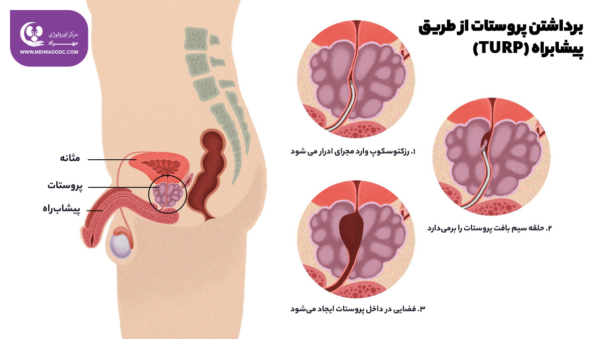 هایپرپلازی خوش‌خیم پروستات |‌دکتر مهری مهراد
