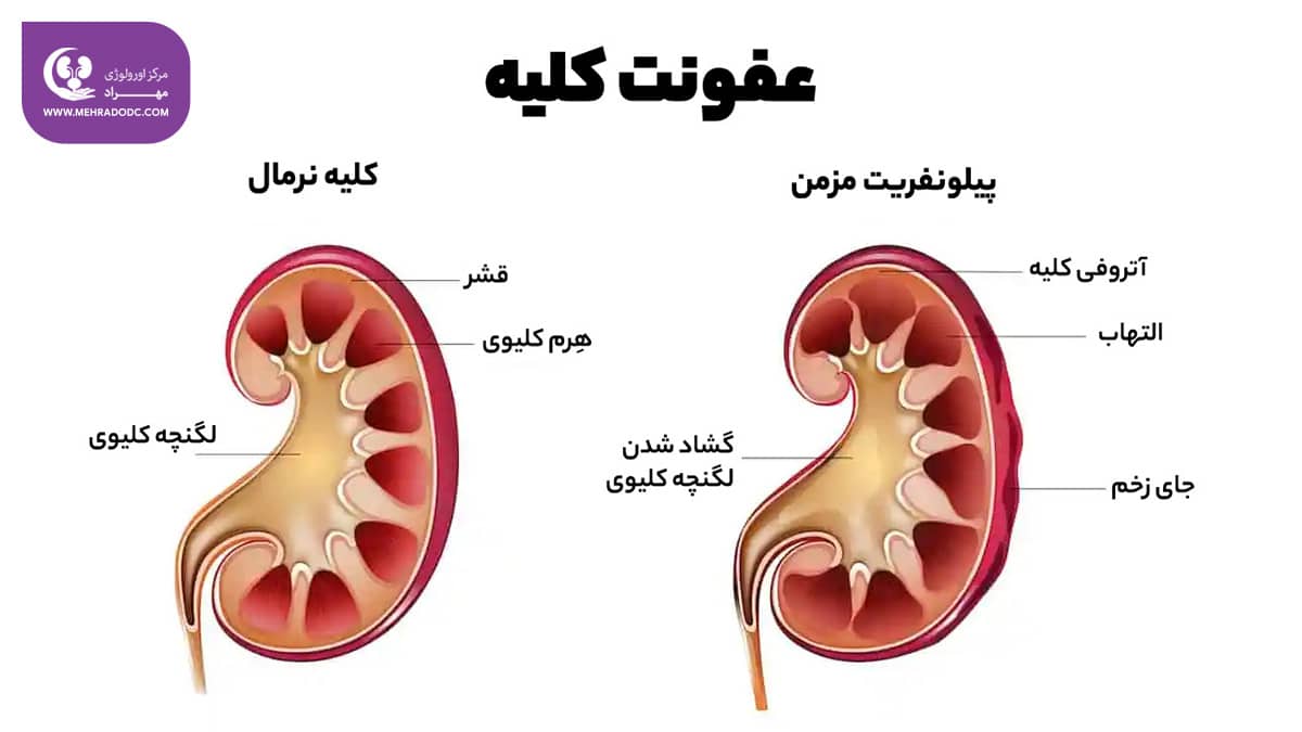 عفونت کلیه یا پیلونفریت |‌ دکتر مهری مهراد