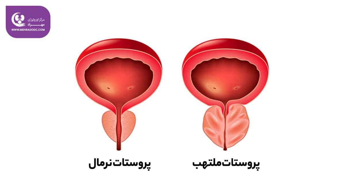 علائم پروستاتیت | کلینیک اورولوژی مهراد