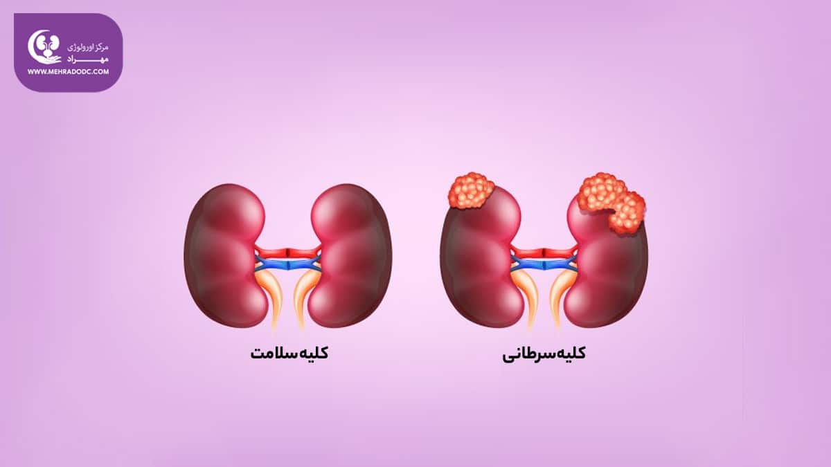 سرطان کلیه | دکتر مهری مهراد - کلینیک اورولوژی مهراد