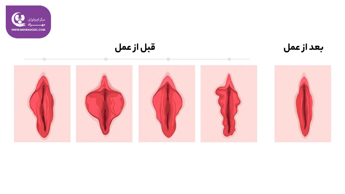لابیا پلاستی و زیباسازی واژن | دکتر مهری مهراد - اورولوژیست