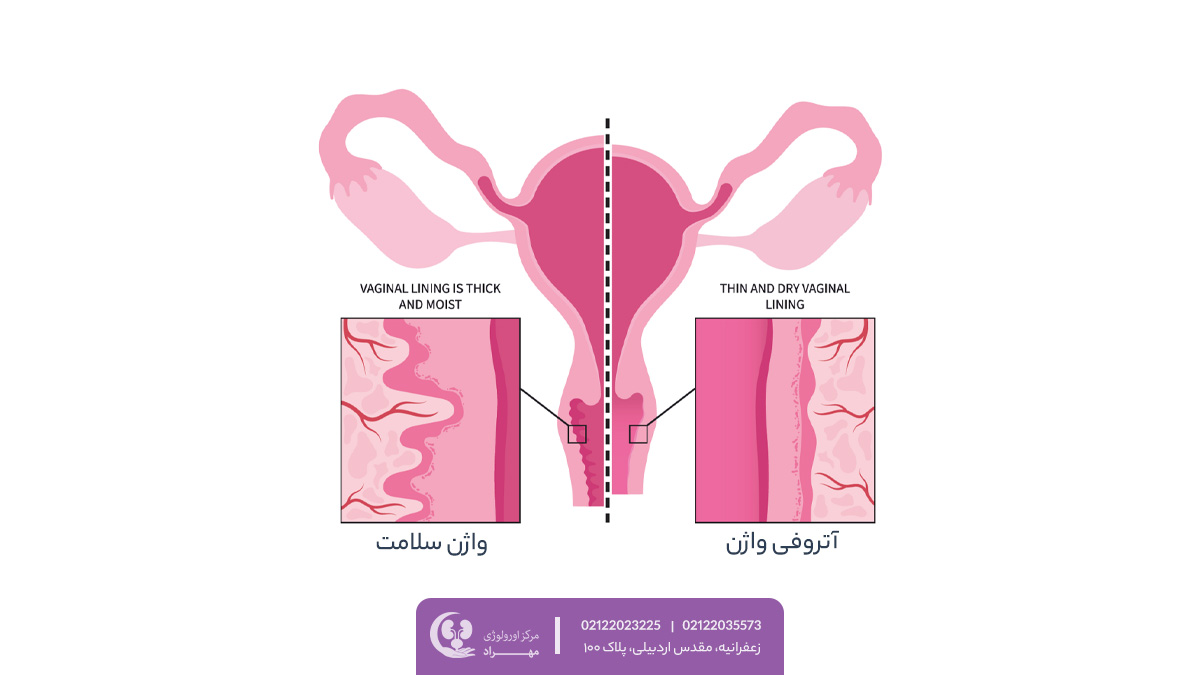آتروفی واژن | دکتر مهری مهراد