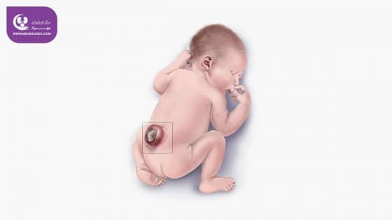 مهره‌شکاف یا اسپینا بیفیدا (Spina Bifida)
