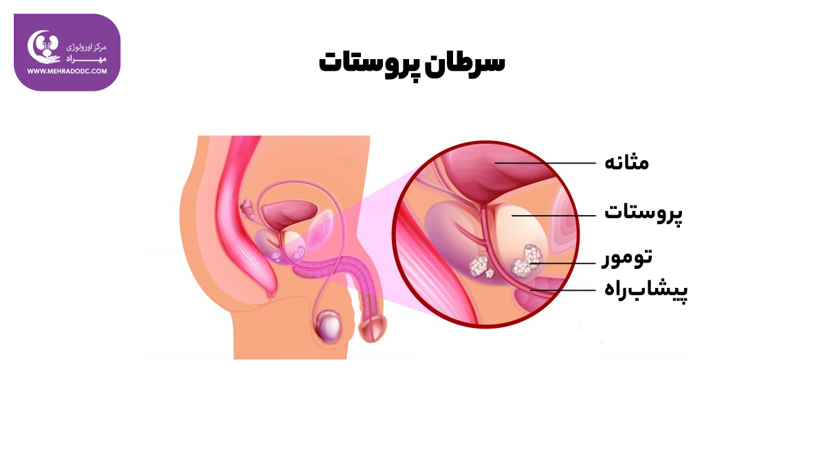 گزینه‌های درمانی سرطان پروستات | کلینیک اورولوژی مهراد