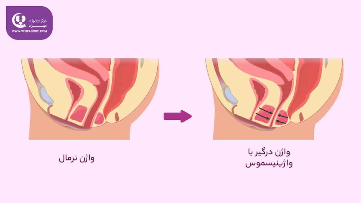 واژینیسموس | دکتر مهری مهراد