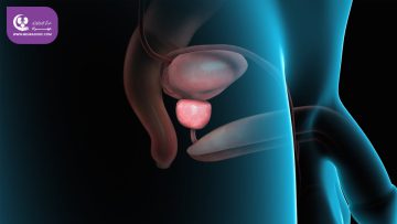 هایپرپلازی خوش‌خیم پروستات (BPH)