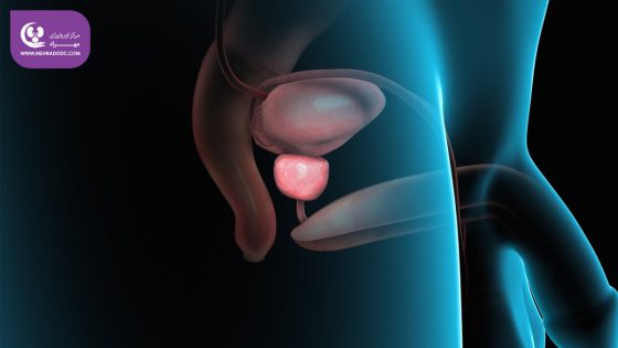 هایپرپلازی خوش‌خیم پروستات (BPH)