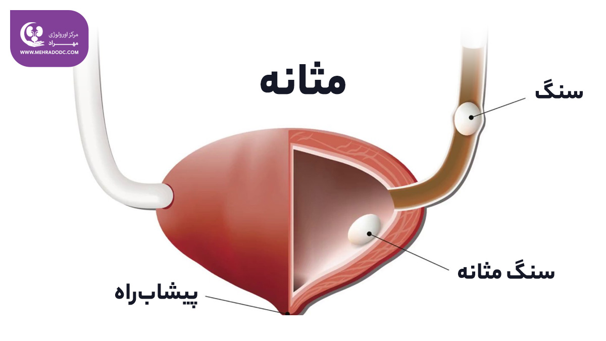 تشخیص سنگ مثانه | کلینیک اورولوژی مهراد