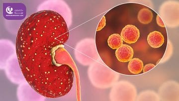 پیلونفریت (عفونت کلیه)