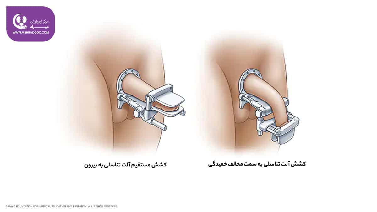 درمان پیرونی یا انحراف آلت تناسلی | دکتر مهری مهراد