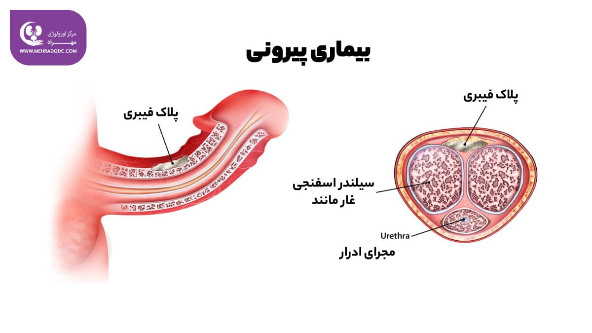 درمان بیماری پیرونی | دکتر مهری مهراد
