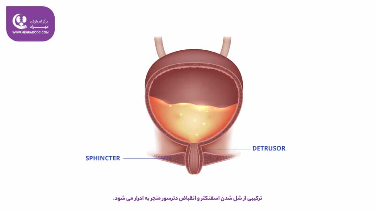 بی اختیاری ادراری استرسی یا SUI | کلینیک اورولوژی مهراد