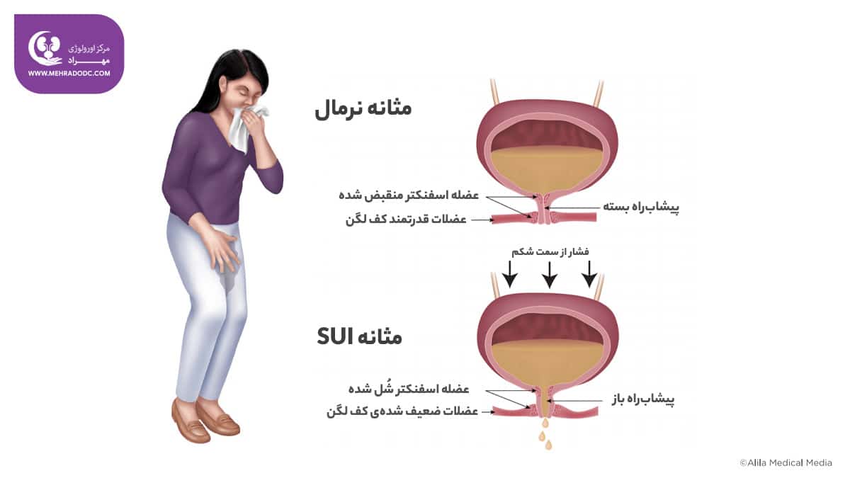 بی اختیاری ادراری استرسی یا SUI | دکتر مهری مهراد، اورولوژیست