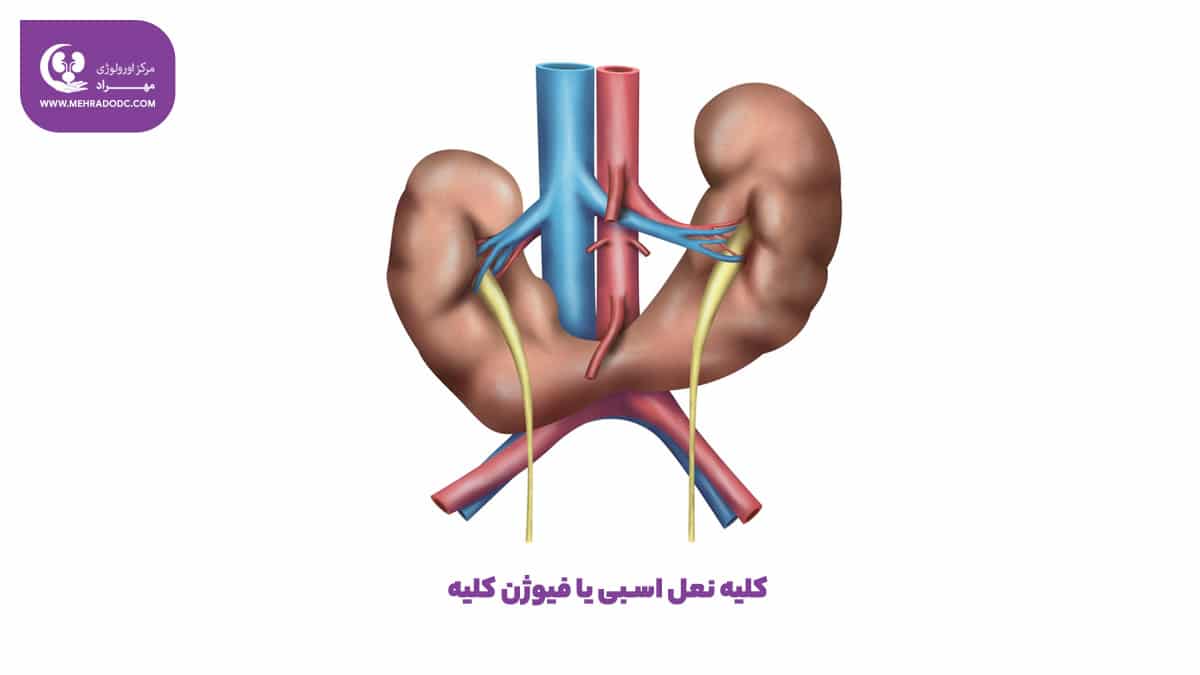 کلیه نعل اسبی یا فیوژن کلیه | دکتر مهری مهراد