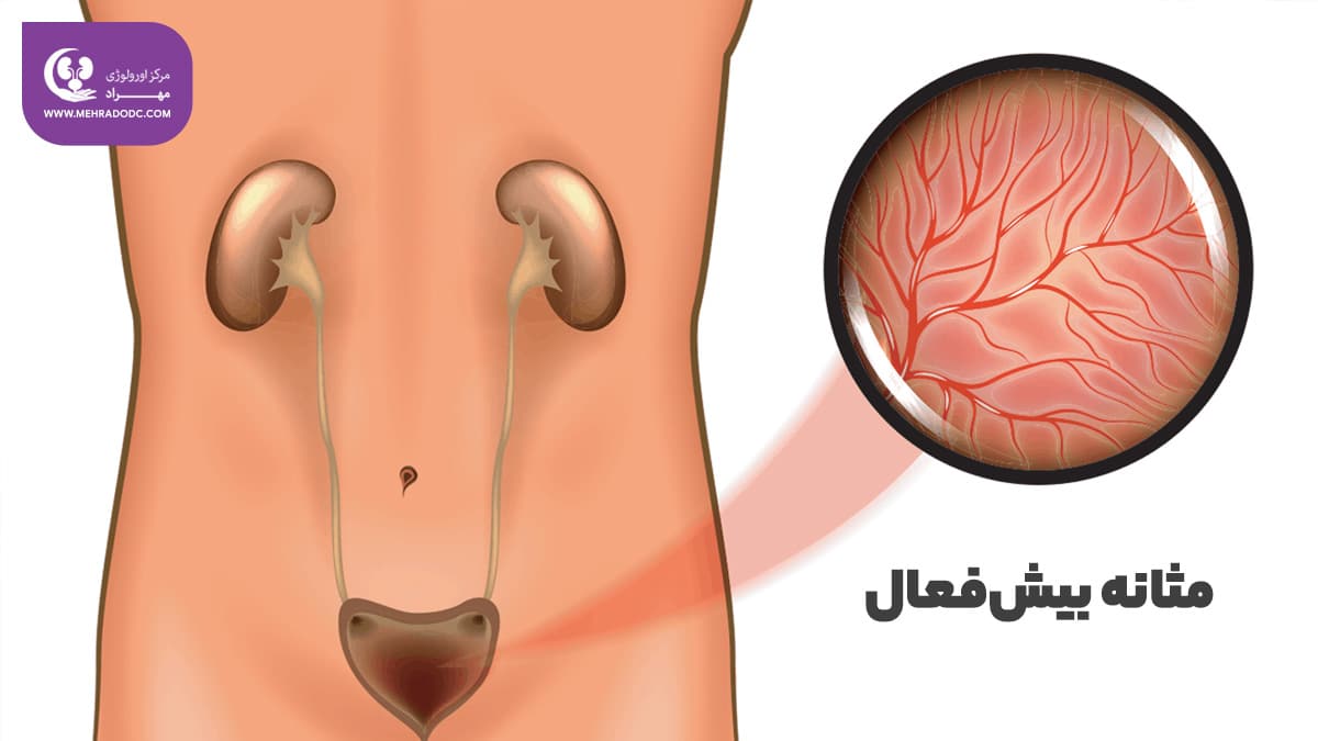 درمان مثانه بیش فعال | دکتر مهری مهراد
