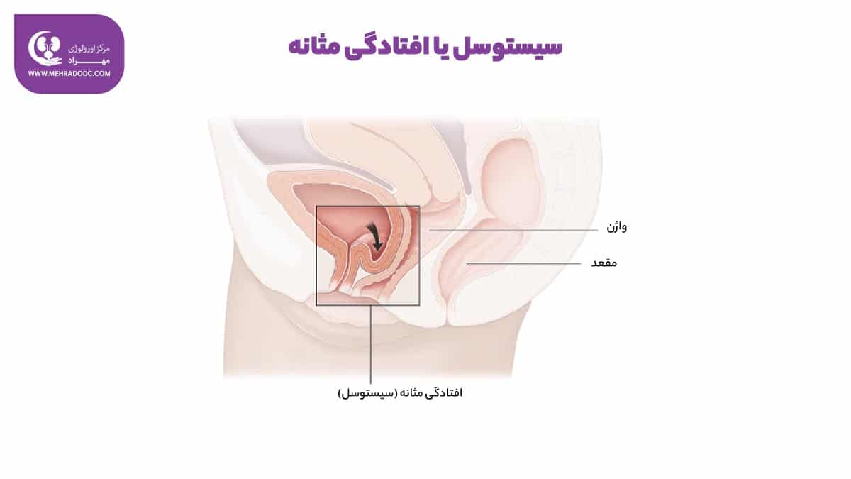 سیستوسل یا افتادگی مثانه | دکتر مهری مهراد