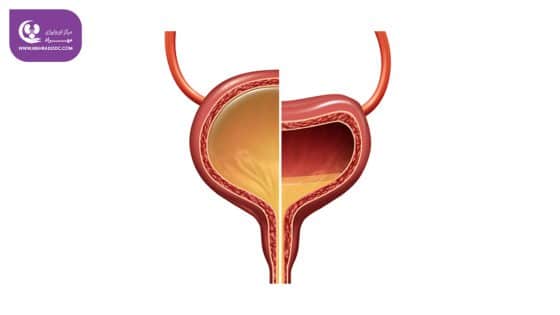 مثانه بیش فعال (OAB)
