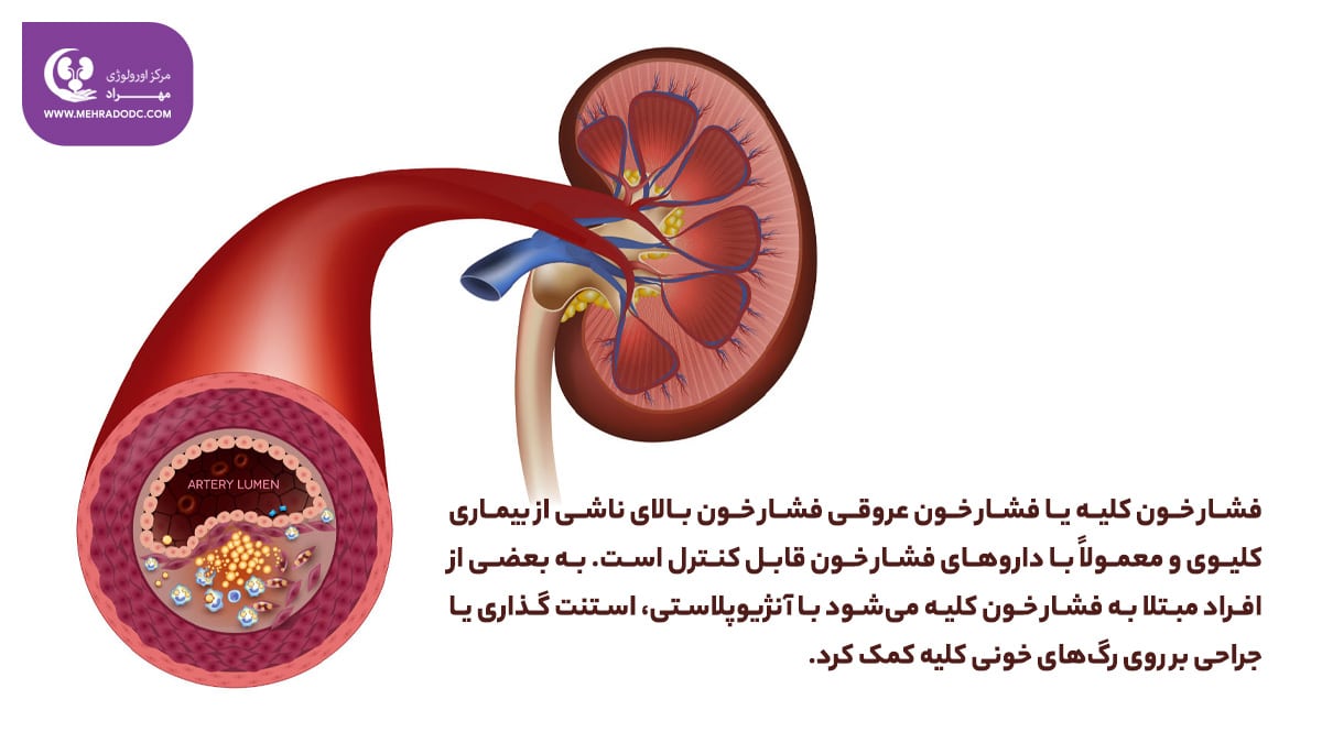 درمان فشار خون کلیه | کلینیک اورولوژی مهراد