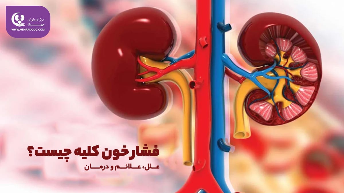 علائم فشار خون کلیه | کلینیک اورولوژی مهراد