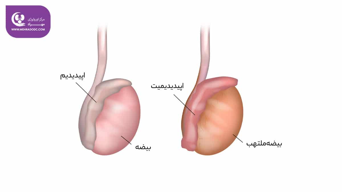 علائم اپیدیدیمیت | دکتر مهری مهراد، اورولوژیست