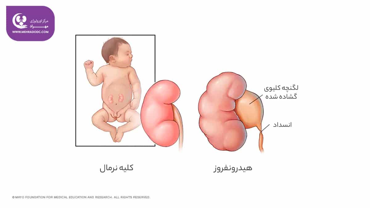 هیدرونفروز چیست؟ | کلینیک اورولوژی مهراد