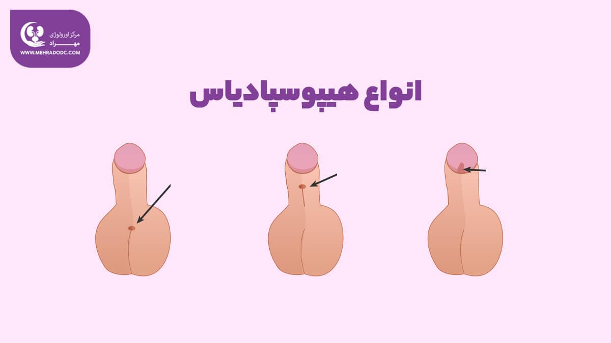 انواع هیپوسپادیاس | دکتر مهری مهراد، اورولوژیست