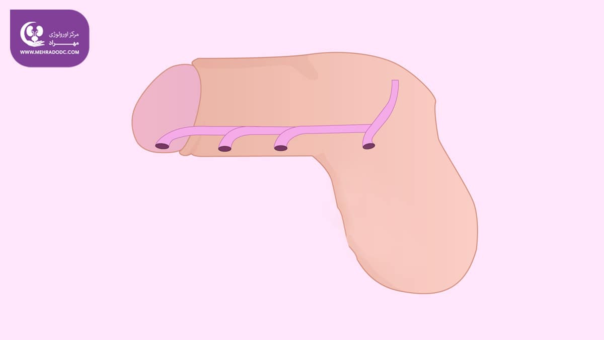 هیپوسپادیاس