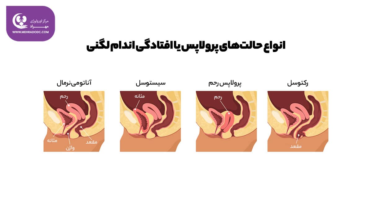 انواع افتادگی با پرولاپس | دکتر مهری مهراد - اورولوژیست در تهران