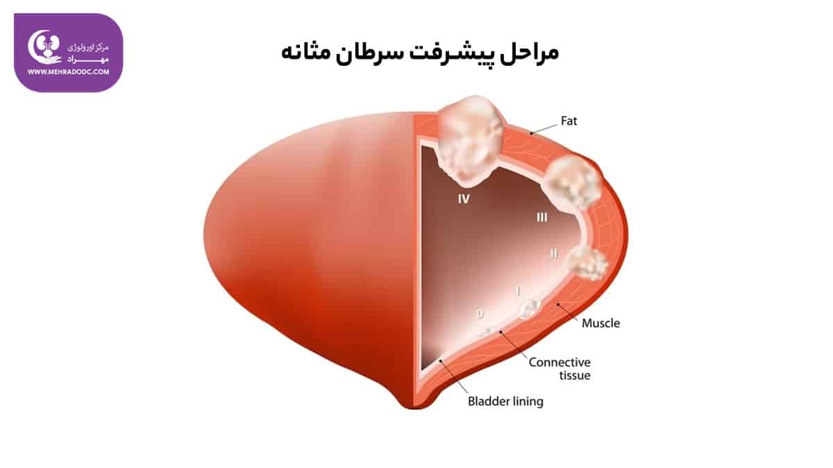 درجه سرطان مثانه | دکتر مهری مهراد، متخصص اورولوژی