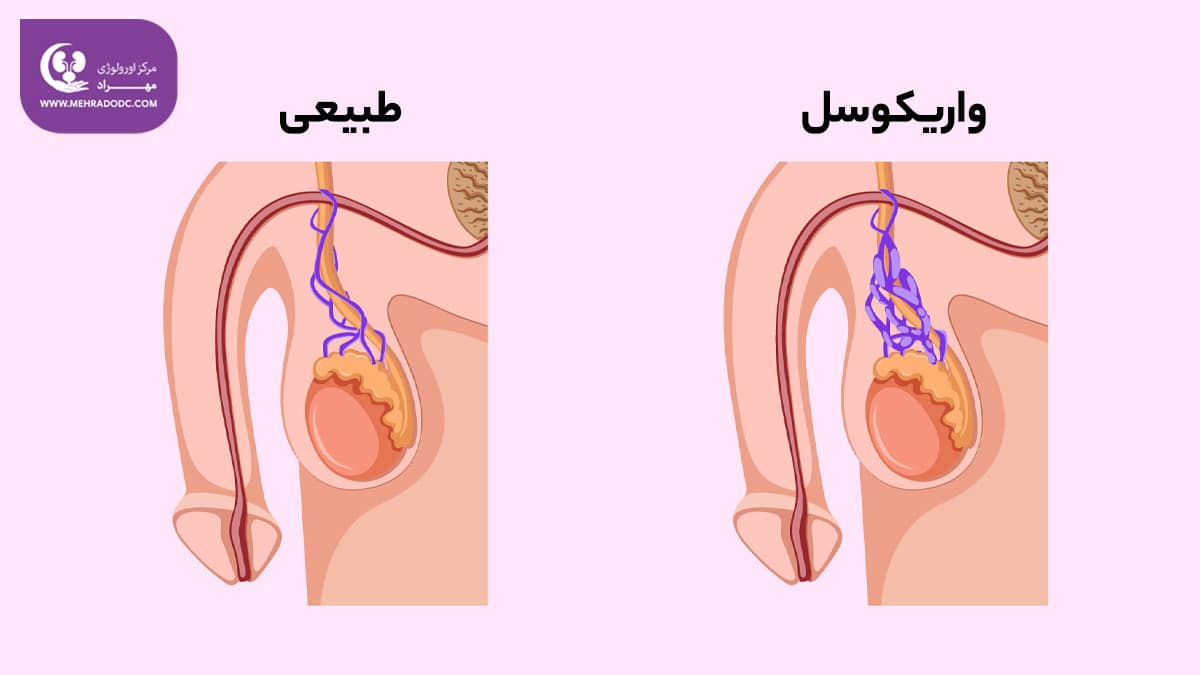 علت های واریکوسل | دکتر مهری مهراد - اورولوژیست