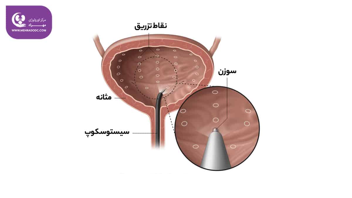تزریق بوتاکس به مثانه | دکتر مهری مهراد - متخصص اورولوژی در تهران