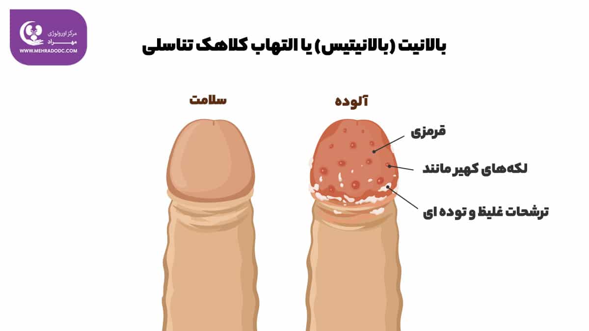 بالانیت (بالانیتیس) یا التهاب کلاهک تناسلی | دکتر مهری مهراد - اورولوژیست