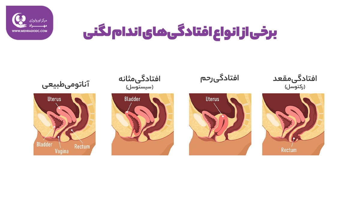 افتادگی اندام لگن | دکتر مهری مهراد - اورولوژیست