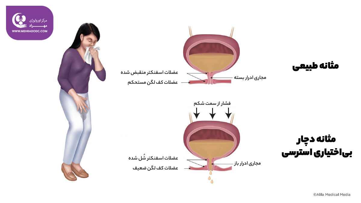 علل بی‌اختیاری استرسی | دکتر مهری مهراد - متخصص اورولوژی