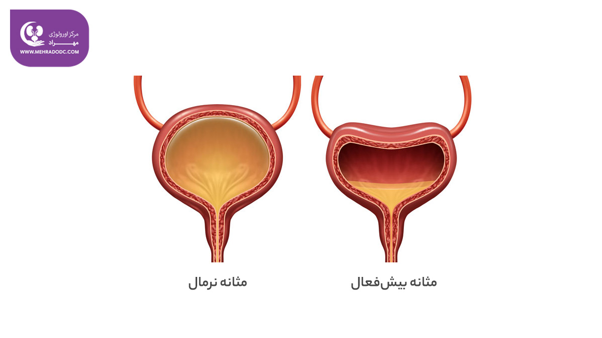 مثانه بیش فعال چیست؟ | دکتر مهری مهراد - متخصص اورولوژی