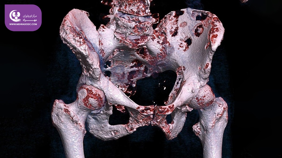 متاستاز استخوان سرطان پروستات | دکتر مهری مهراد - اورولوژیست