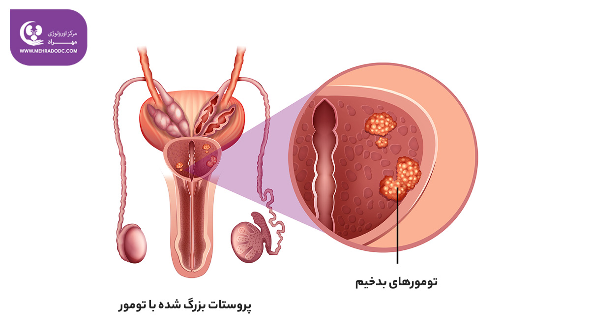 سرطان پروستات پیشرفته | دکتر مهری مهراد - متخصص اورولوژی در تهران