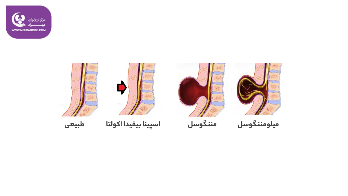 تفاوت بین میلومننگوسل و مننگوسل | دکتر مهری مهراد - اورولوژیست