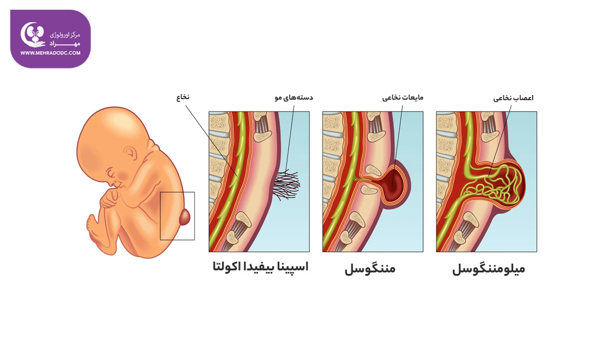 شباهت های مننگوسل و میلومننگوسل | دکتر مهری مهراد 