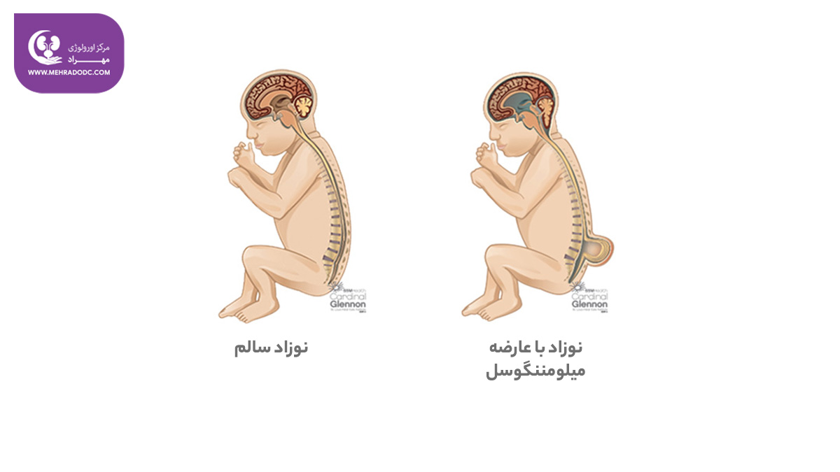 مننگوسل و میلومننگوسل | دکتر مهری مهراد، بهترین اورولوژیست تهران