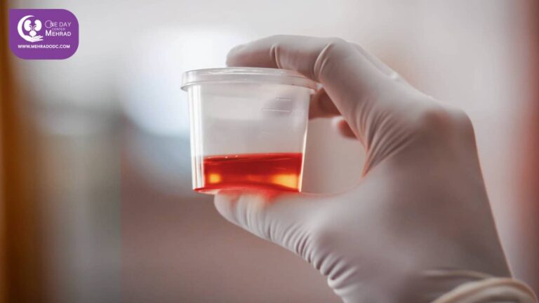 Diagnosis and treatment of Hematuria (Red blood cells in the urine)